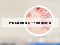 吃什么能治银屑 吃什么治银屑病的犀