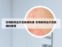 生物制剂治疗皮肤病效果 生物制剂治疗皮肤病的原理