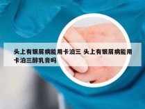 头上有银屑病能用卡泊三 头上有银屑病能用卡泊三醇乳膏吗