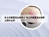 头上长癣是怎么回事儿 头上长癣是怎么回事儿用什么药