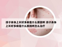 孩子身体上长好多癣是什么原因啊 孩子身体上长好多癣是什么原因啊怎么治疗