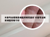 长春专业看银屑病医院哪家最好 长春专治银屑病医院哪个好