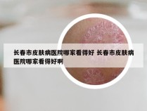 长春市皮肤病医院哪家看得好 长春市皮肤病医院哪家看得好啊