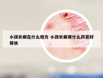 小孩长癣在什么地方 小孩长癣用什么药膏好得快