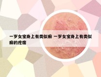 一岁女宝身上有类似癣 一岁女宝身上有类似癣的疙瘩