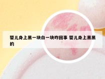 婴儿身上黑一块白一块咋回事 婴儿身上黑黑的