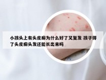 小孩头上有头皮癣为什么好了又复发 孩子得了头皮癣头发还能长出来吗