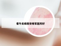 看牛皮癣西安哪家医院好