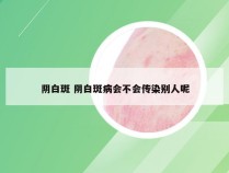 阴白斑 阴白斑病会不会传染别人呢