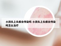 小孩头上头癣会传染吗 小孩头上头癣会传染吗怎么治疗