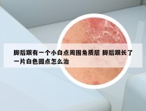 脚后跟有一个小白点周围角质层 脚后跟长了一片白色圆点怎么治