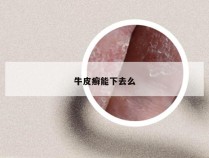 牛皮癣能下去么