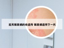 后天银屑病的也遗传 银屑病遗传下一代