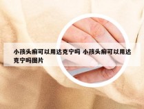 小孩头癣可以用达克宁吗 小孩头癣可以用达克宁吗图片