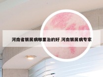 河南省银屑病哪里治的好 河南银屑病专家