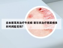 日本萌耳夫治疗牛皮癣 萌尔夫治疗银屑病多长时间能见效?