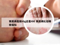 银屑病是做IGg还是IGE 银屑病化验哪些指标