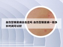 血热型银屑病会自愈吗 血热型银屑病一般多长时间可以好