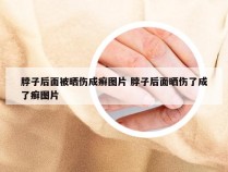 脖子后面被晒伤成癣图片 脖子后面晒伤了成了癣图片