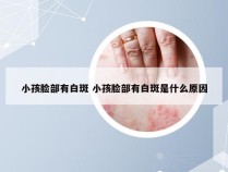 小孩脸部有白斑 小孩脸部有白斑是什么原因