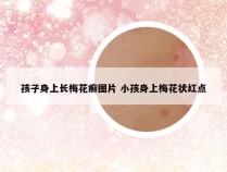 孩子身上长梅花癣图片 小孩身上梅花状红点