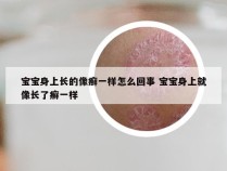 宝宝身上长的像癣一样怎么回事 宝宝身上就像长了癣一样