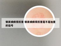 银屑病痒得厉害 银屑病痒得厉害是不是加重的信号