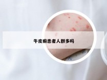 牛皮癣患者人群多吗