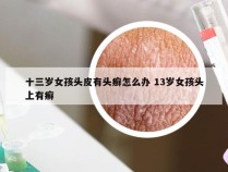 十三岁女孩头皮有头癣怎么办 13岁女孩头上有癣