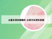 儿童头顶长癣图片 小孩子头顶长皮癣