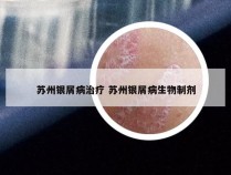 苏州银屑病治疗 苏州银屑病生物制剂