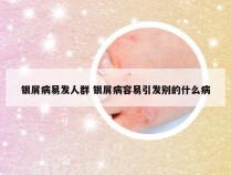 银屑病易发人群 银屑病容易引发别的什么病