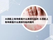 小孩脸上有块癣是什么原因引起的 小孩脸上有块癣是什么原因引起的图片