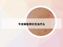 牛皮癣能照红光治疗么