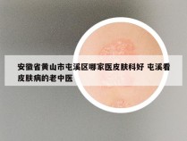 安徽省黄山市屯溪区哪家医皮肤科好 屯溪看皮肤病的老中医