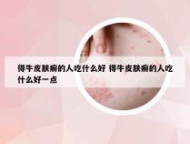 得牛皮肤癣的人吃什么好 得牛皮肤癣的人吃什么好一点