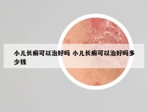 小儿长癣可以治好吗 小儿长癣可以治好吗多少钱